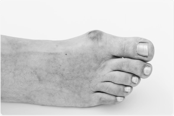 Bunion image