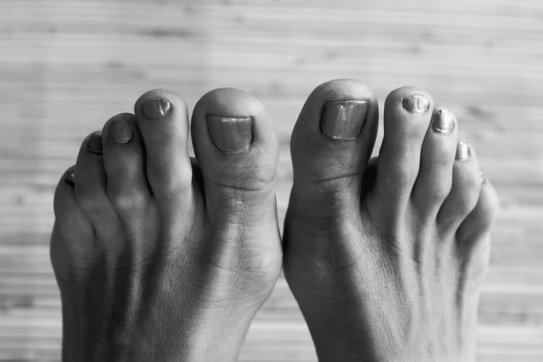 Hammertoe image