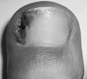 Ingrown toenail image